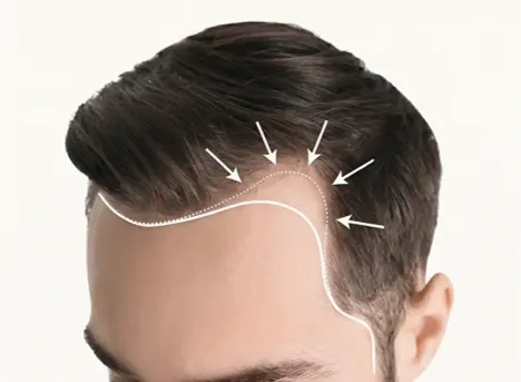 Receding hairline